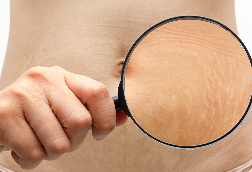 Коррекция стрий